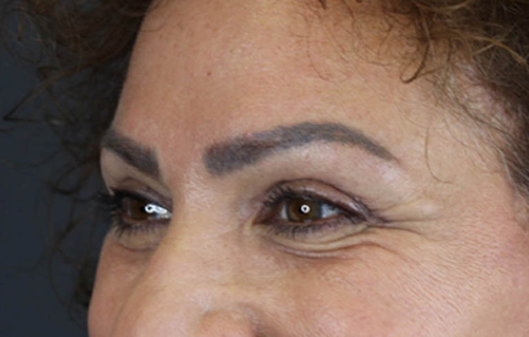 Blepharoplasty case #9929