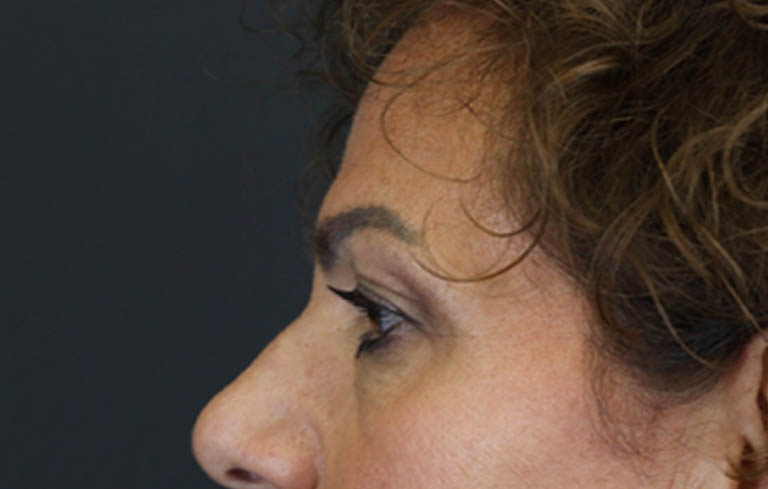 Blepharoplasty case #9929