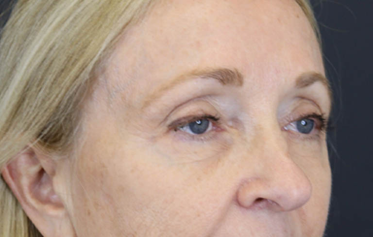 Brow Lift case #9943