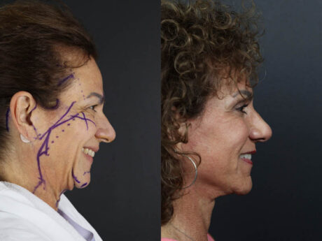 C02 Laser case #9916