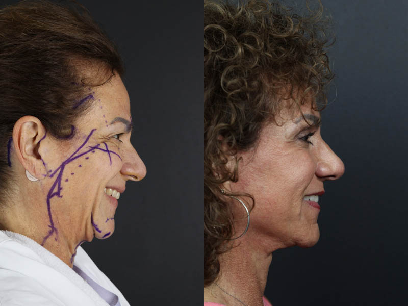 C02 Laser case #9916