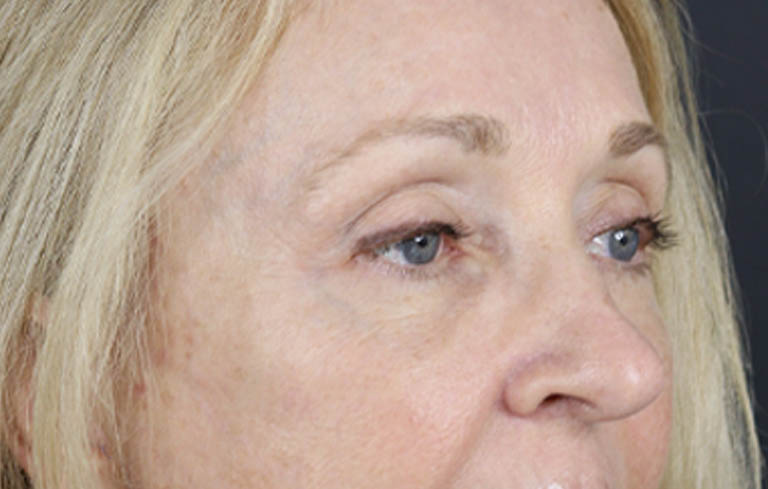 Brow Lift case #9943