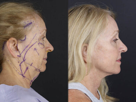 Facelift case #9905