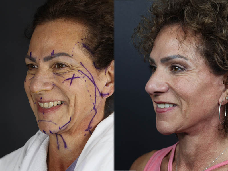 C02 Laser case #9916