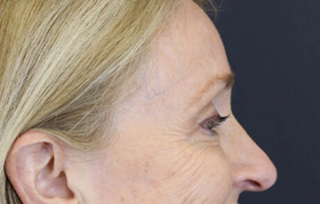 Brow Lift case #9943