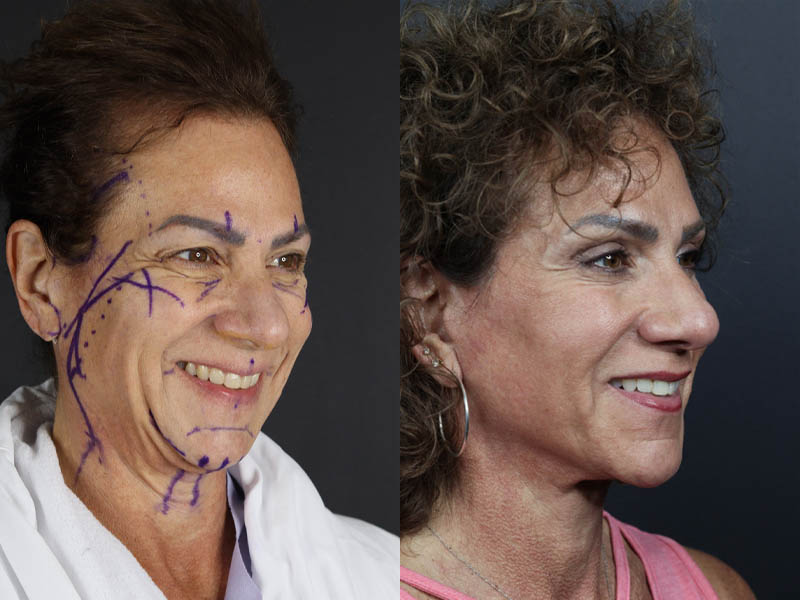 C02 Laser case #9916