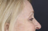 Brow Lift case #9943