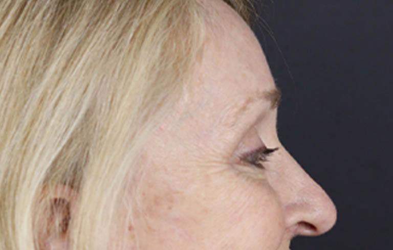 Brow Lift case #9943