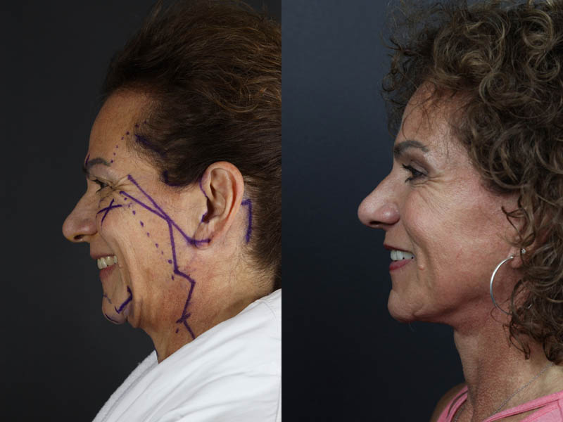 C02 Laser case #9916