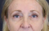 Brow Lift case #9943