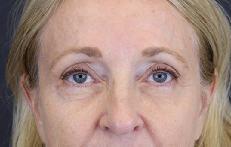 Brow Lift case #9943