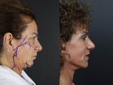 C02 Laser case #9916