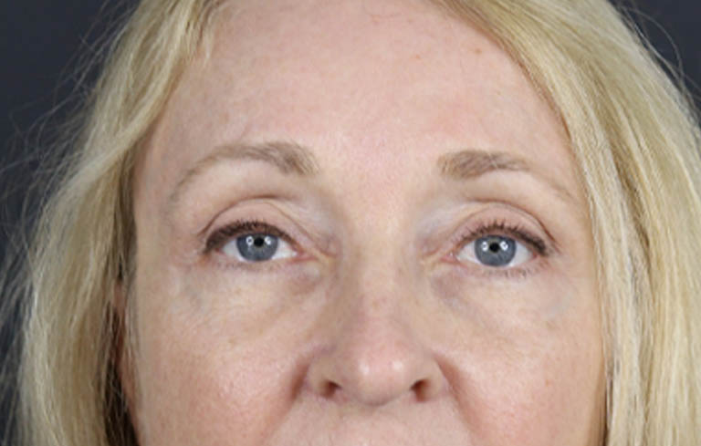 Brow Lift case #9943