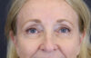 Brow Lift case #9943