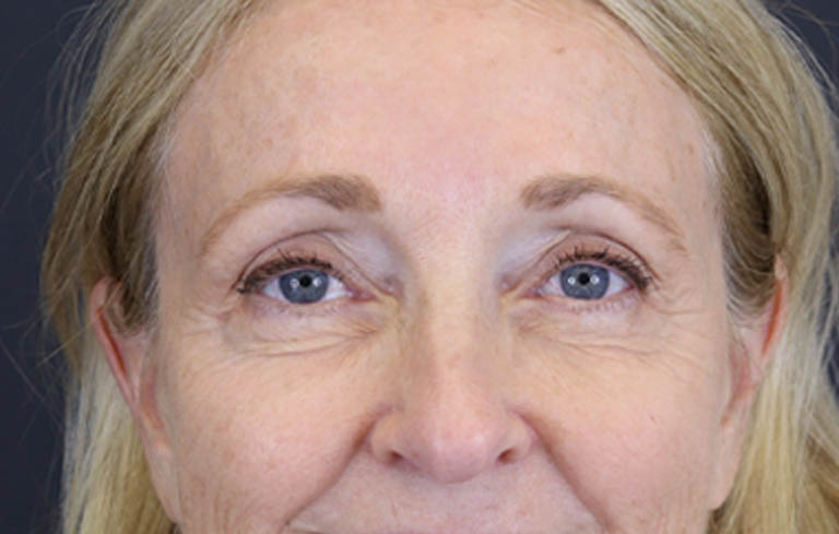Brow Lift case #9943