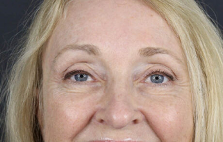 Brow Lift case #9943