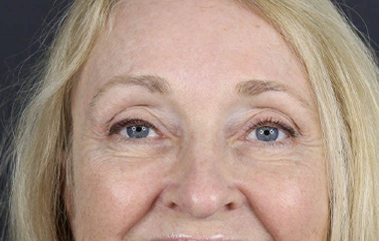 Brow Lift case #9943