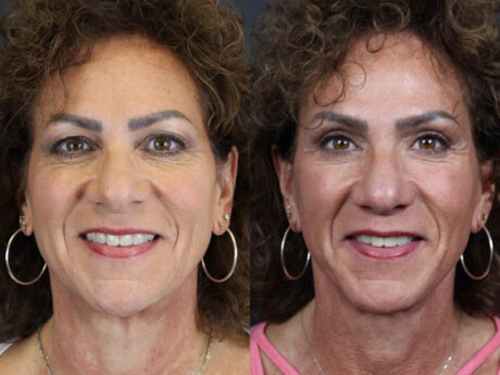 C02 Laser case #9916