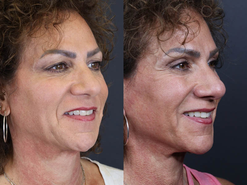 C02 Laser case #9916