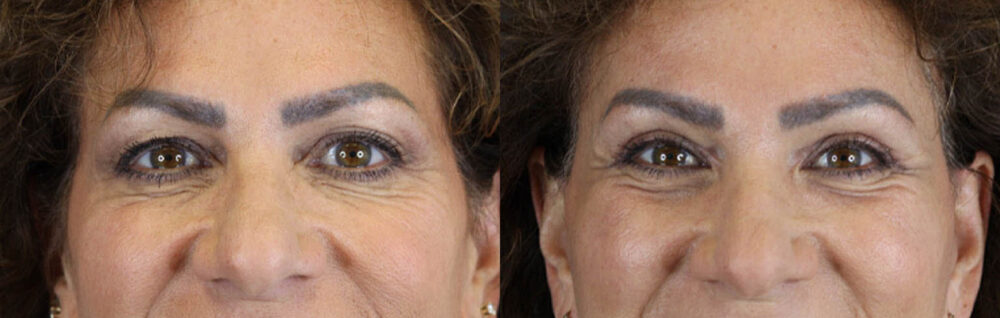 Blepharoplasty case #9929