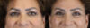 Blepharoplasty case #9929 slider thumbnail