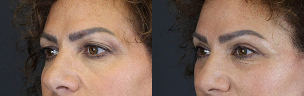 Blepharoplasty case #9929