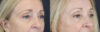 Brow Lift case #9943 slider thumbnail