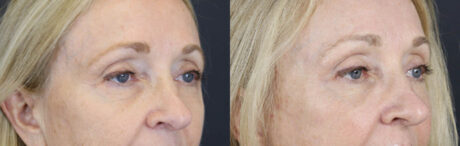 Brow Lift case #9943