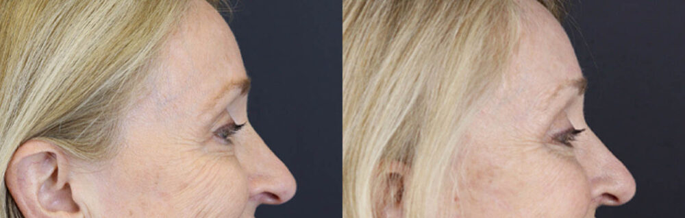 Brow Lift case #9943