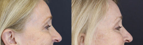 Brow Lift case #9943