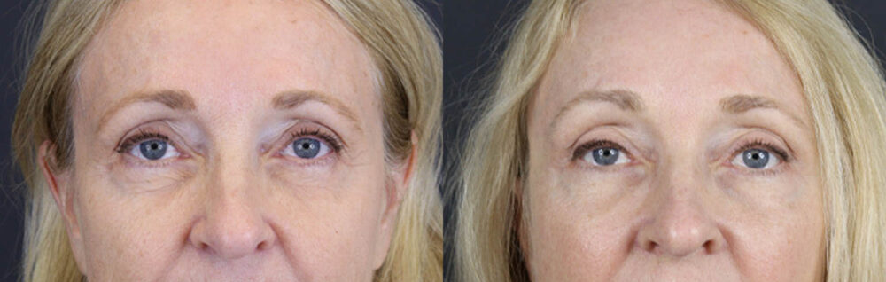 Brow Lift case #9943