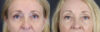 Brow Lift case #9943 slider thumbnail