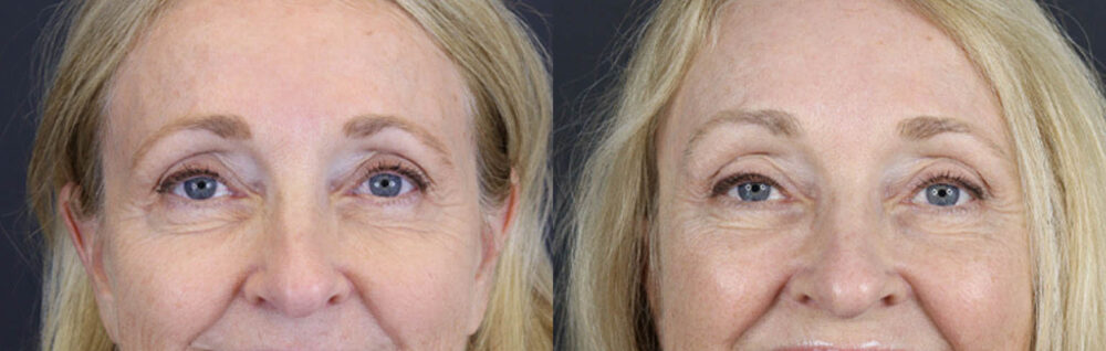 Brow Lift case #9943