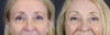 Brow Lift case #9943 slider thumbnail