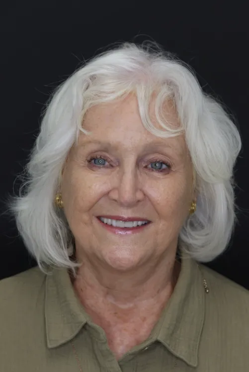 botox-before