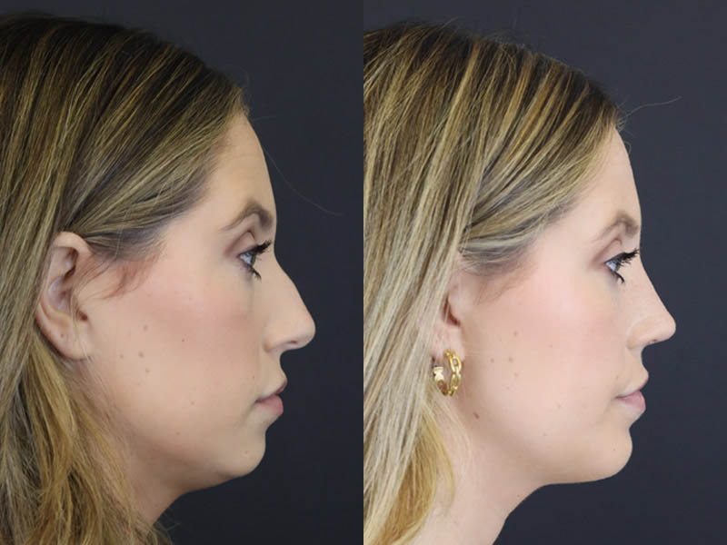 Before and after Plastic Surgery Results | Raggio MD Birmingham, Al