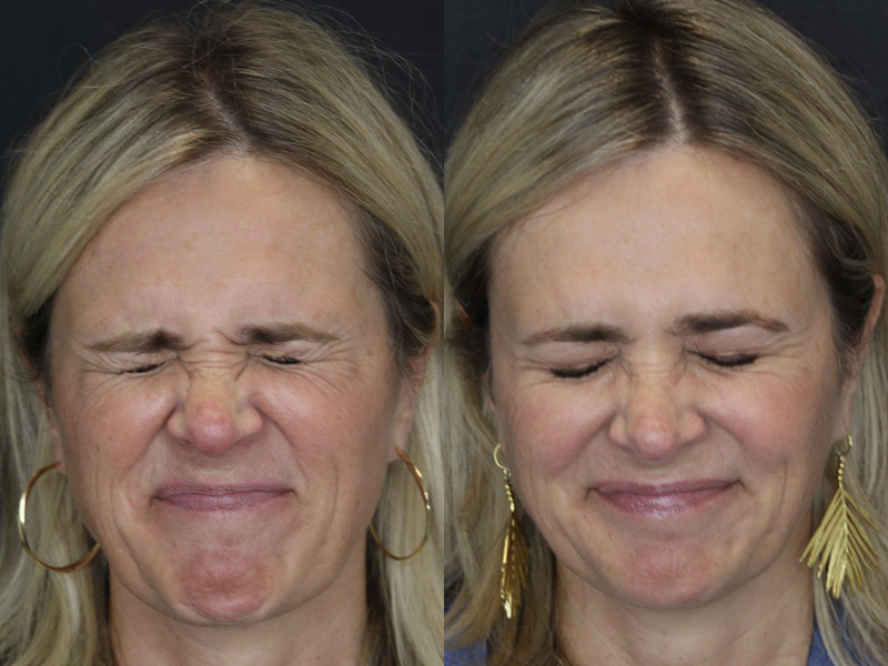 Before and After Plastic Surgery Results | Raggio MD Birmingham, Al
