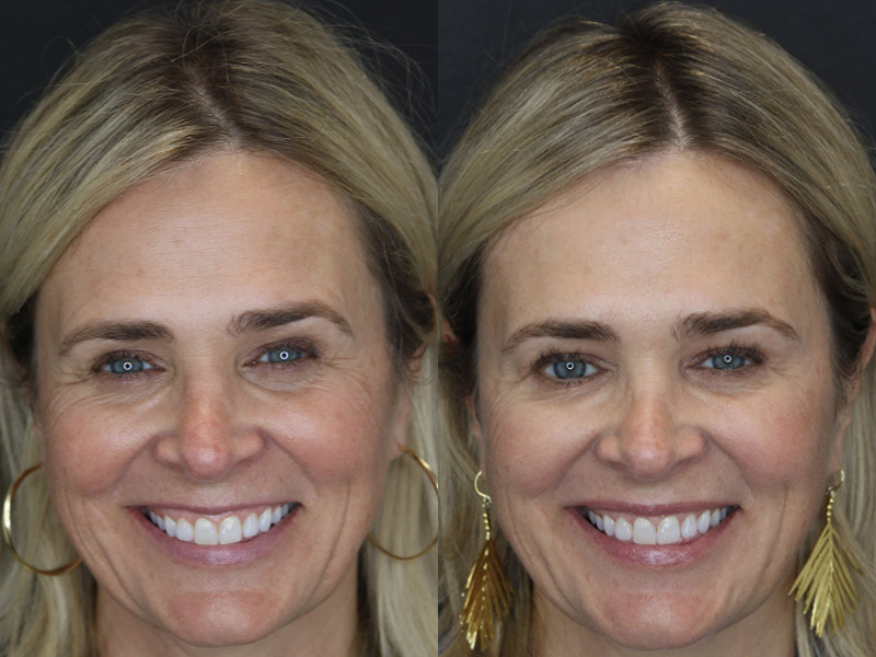 Before and After Plastic Surgery Results | Raggio MD Birmingham, Al