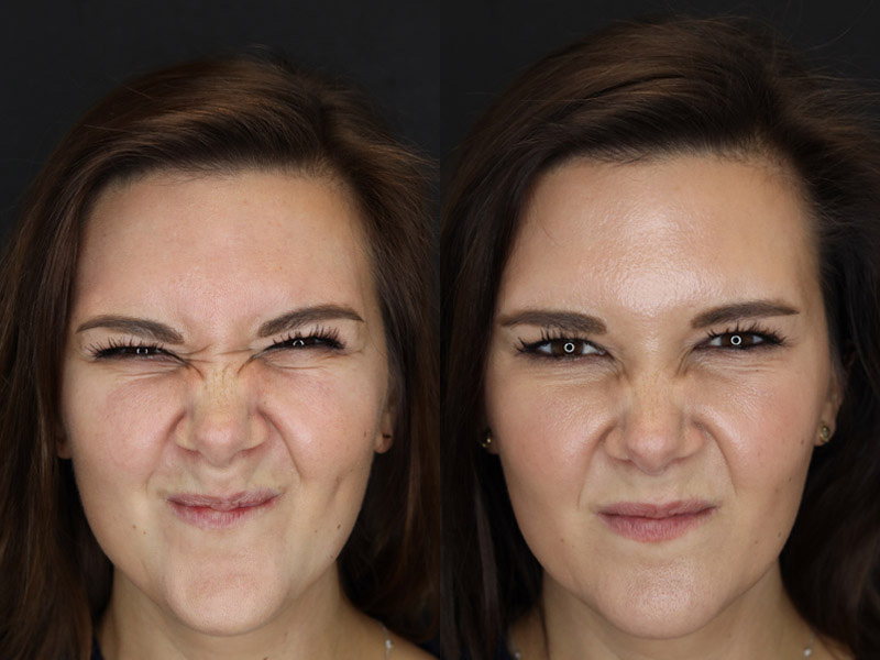 Before and After Plastic Surgery Results | Raggio MD Birmingham, Al
