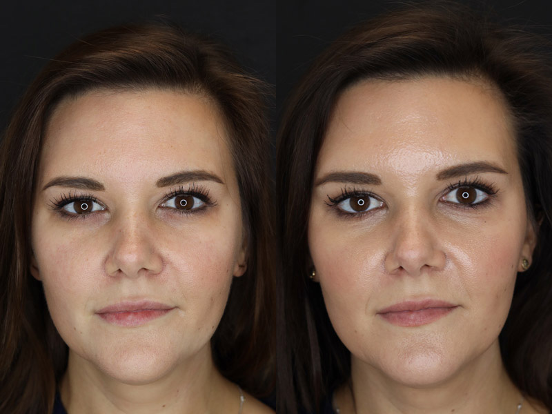 Before and After Plastic Surgery Results | Raggio MD Birmingham, Al