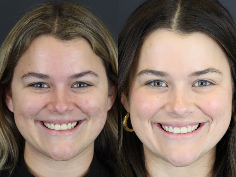 Before and After Plastic Surgery Results | Raggio MD Birmingham, Al