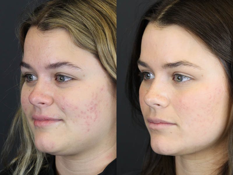 Before and After Plastic Surgery Results | Raggio MD Birmingham, Al