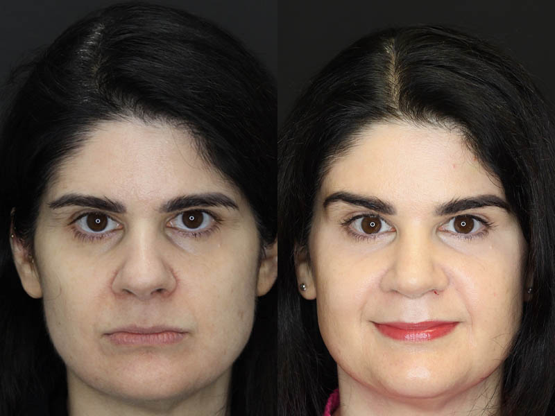 Before and After Plastic Surgery Results | Raggio MD Birmingham, Al