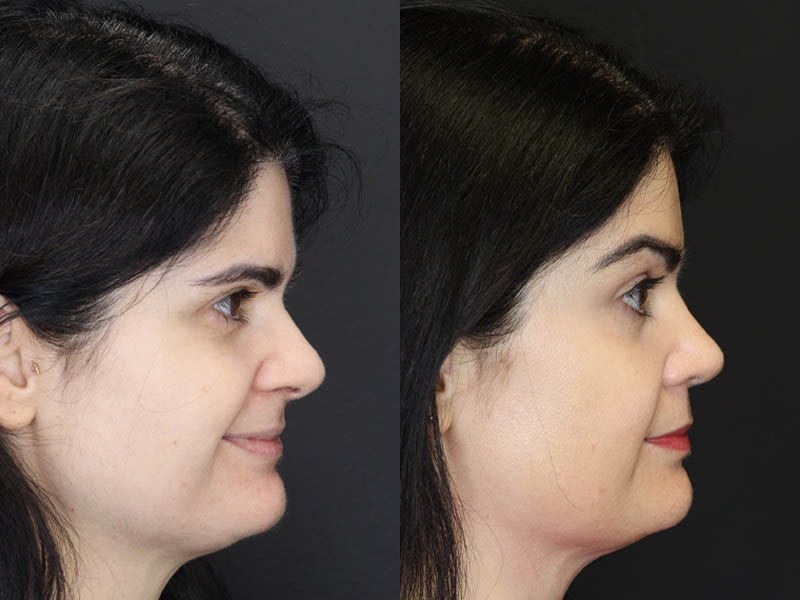 Before and After Plastic Surgery Results | Raggio MD Birmingham, Al