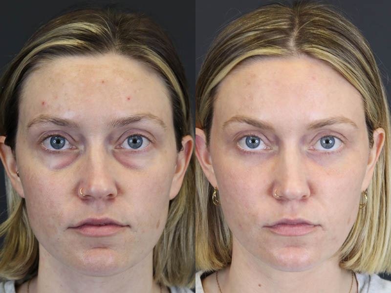 Before and After Plastic Surgery Results | Raggio MD Birmingham, Al