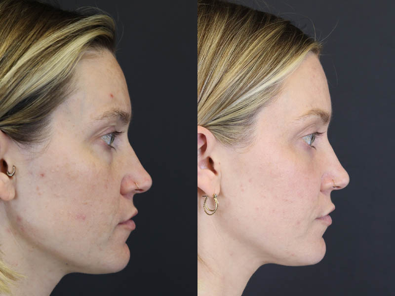 Before and After Plastic Surgery Results | Raggio MD Birmingham, Al