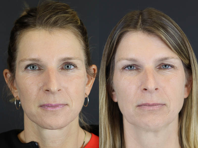 Before and After Plastic Surgery Results | Raggio MD Birmingham, Al