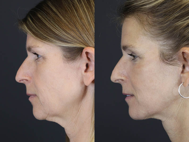 Before and After Plastic Surgery Results | Raggio MD Birmingham, Al