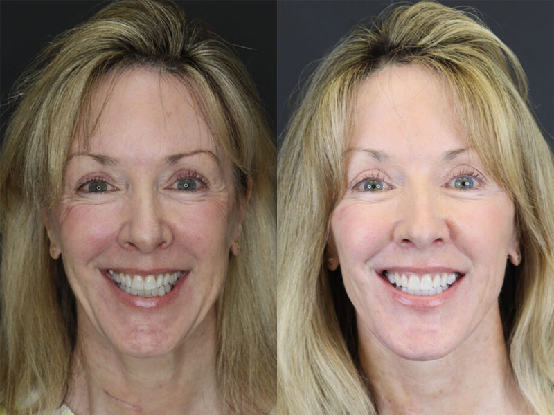 Before and After Plastic Surgery Results | Raggio MD Birmingham, Al