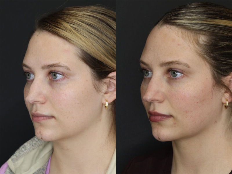 Before and After Plastic Surgery Results | Raggio MD Birmingham, Al